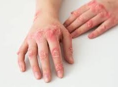 ما هو مرض الزهري