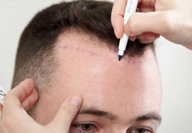 زراعة الشعر في السعودية 2022