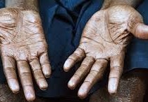 ما هو الجذام