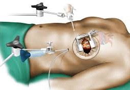 ما هي عملية القلب المفتوح