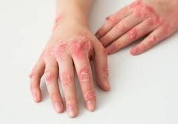 ما هو مرض الزهري